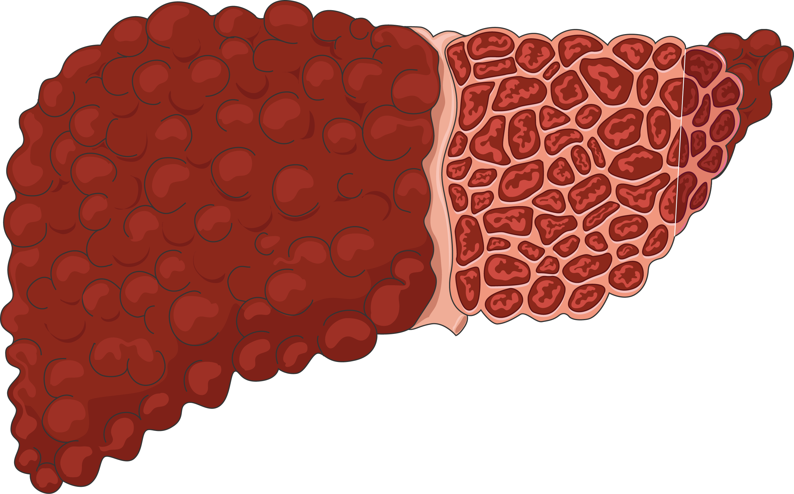 Vector Illustration Cirrhosis Liver Healthy Liver Stock Vector AI