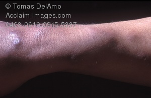 arm clipart bruised