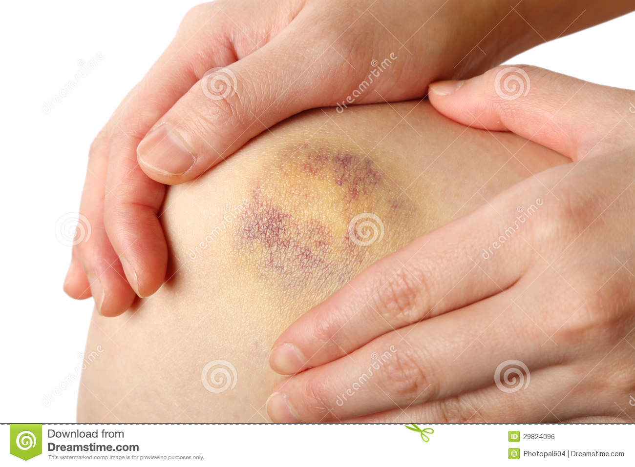 arms clipart bruised