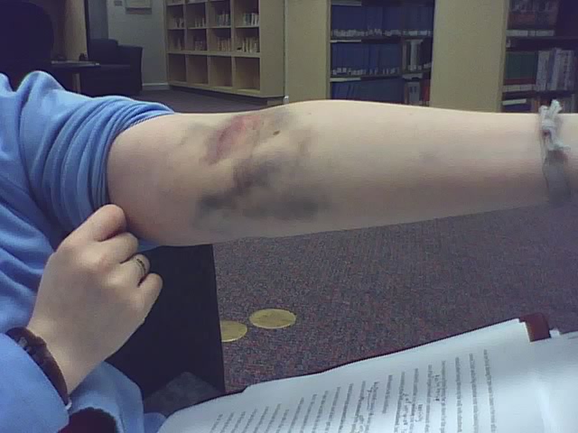 Arms clipart bruised. Remember that donating blood
