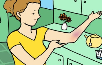 How to get rid. Arms clipart bruised