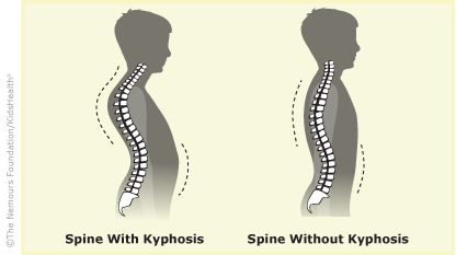 Back clipart back bone. Problem kyphosis illustration