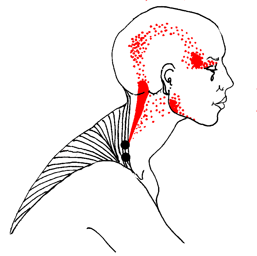 Back clipart neck pain. The upper trapezius refers
