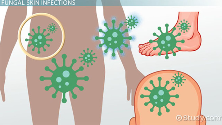 Yeast skin infections vocabulary. Bacteria clipart fungal infection