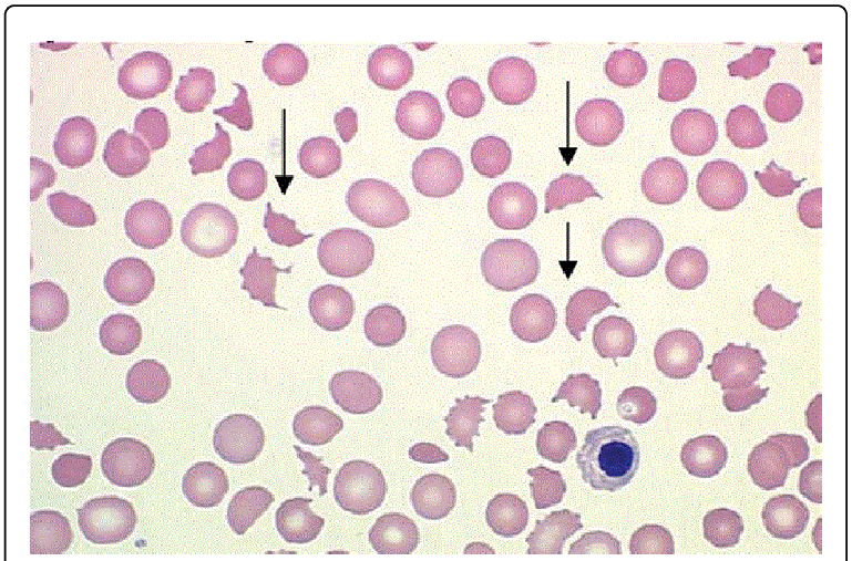 Peripheral of a patient. Blood smear png