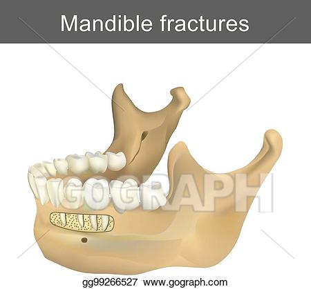 Bone clipart body. Vector art mandible fractures