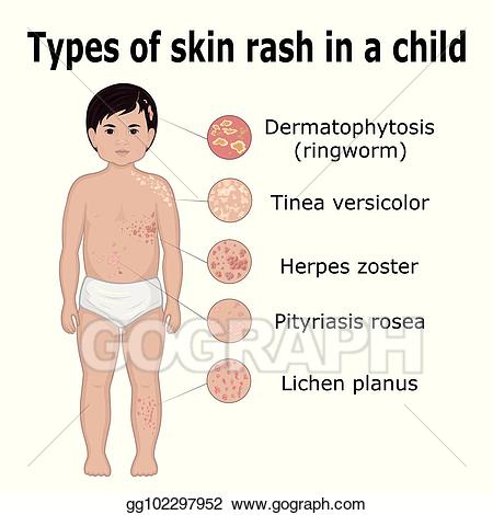 Vector types of rash. Body clipart skin