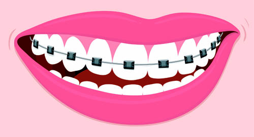 braces clipart black and white