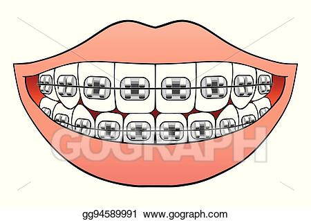 Braces Clipart Clip Art, Braces Clip Art Transparent Free For Download 