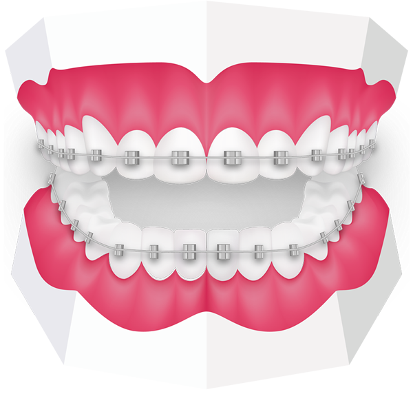 Braces clipart dental brace. For kids richmond london