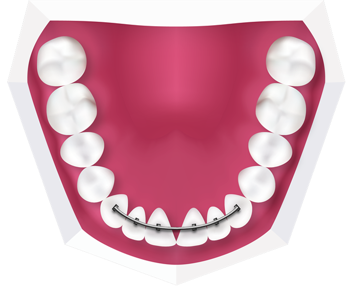 braces clipart dental brace