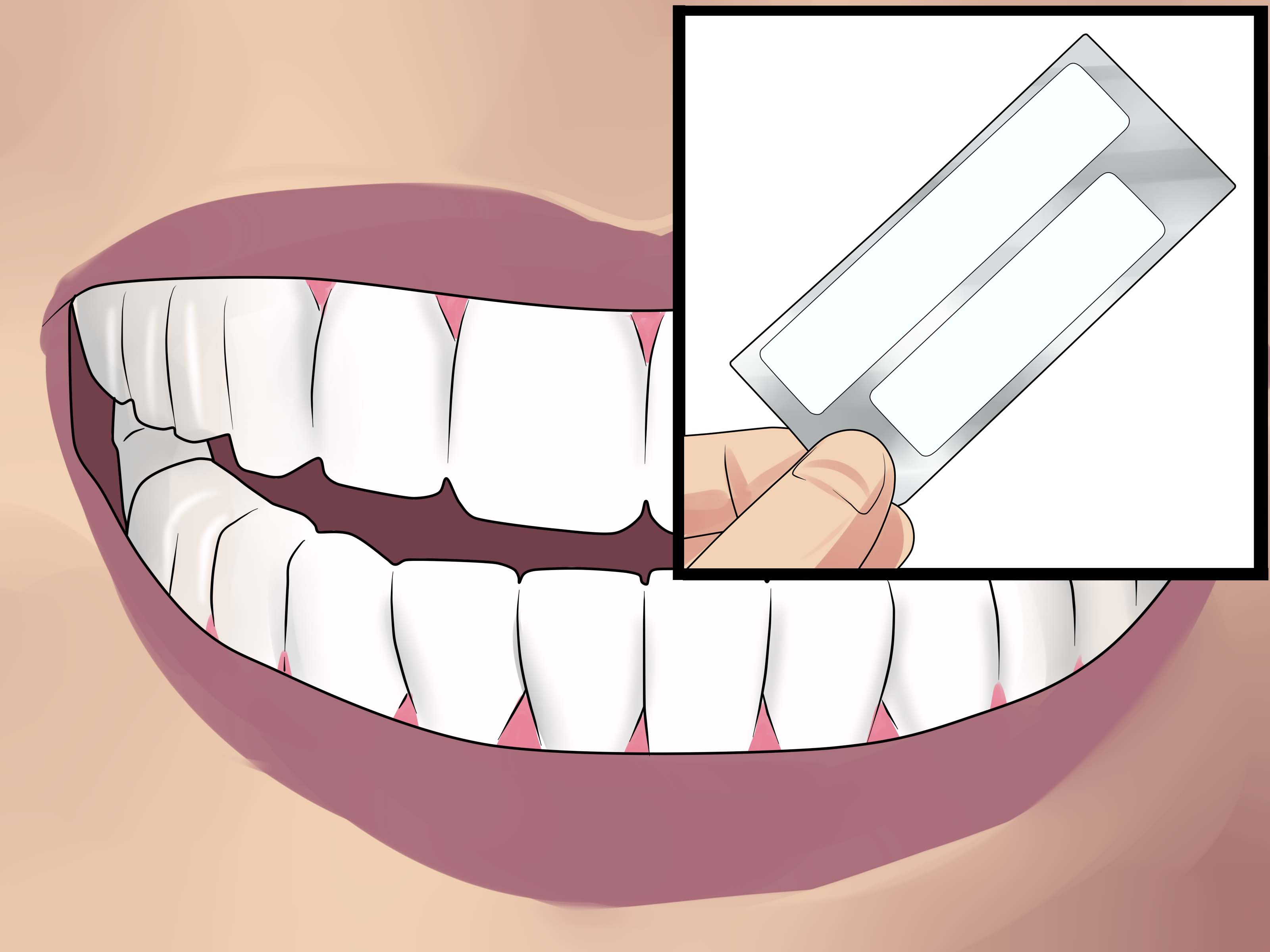 braces clipart dientes