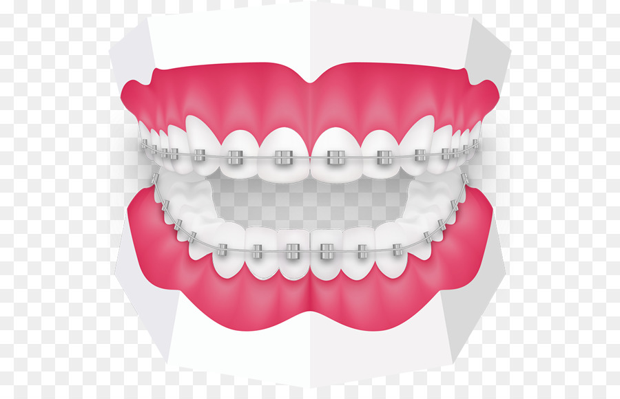 Braces clipart human tooth. 
