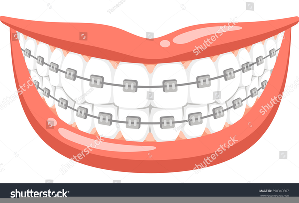 braces clipart large