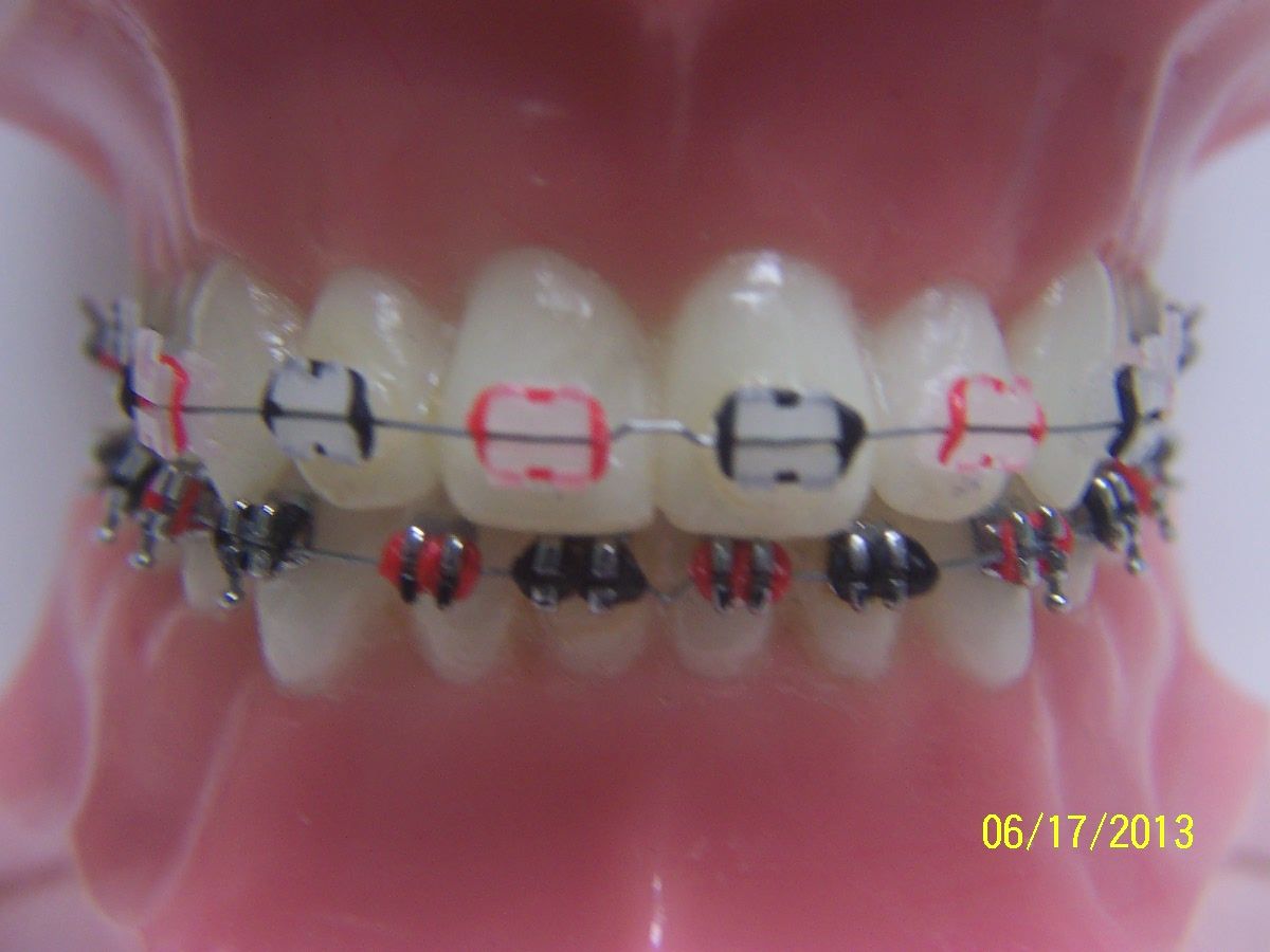 braces clipart tooth brace