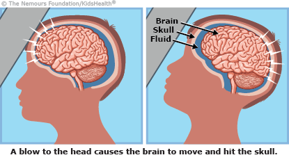 brain clipart concussion