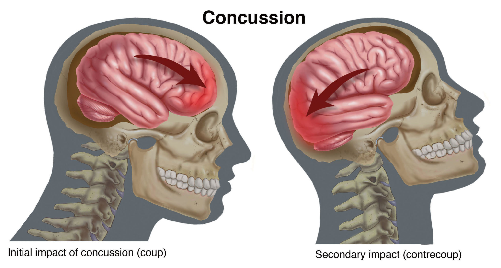 brain clipart concussion