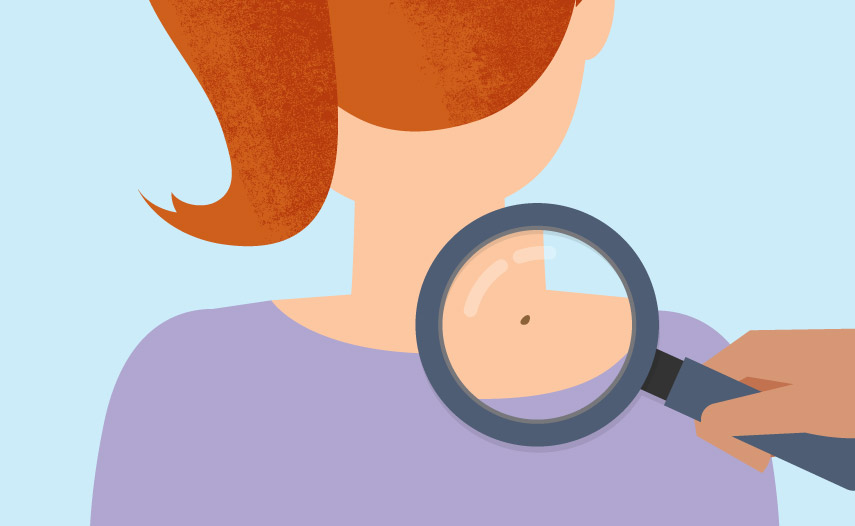 Skin clipart melanoma.  collection of cancer
