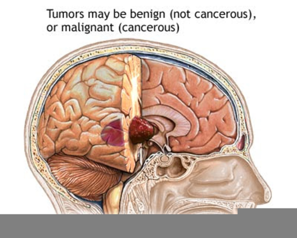 Diagram free images at. Cancer clipart brain cancer