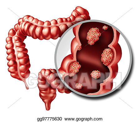 Drawing colon concept gg. Cancer clipart malignant
