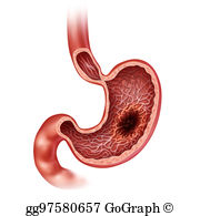 Cancer clipart malignant. Drawing stomach shows growth