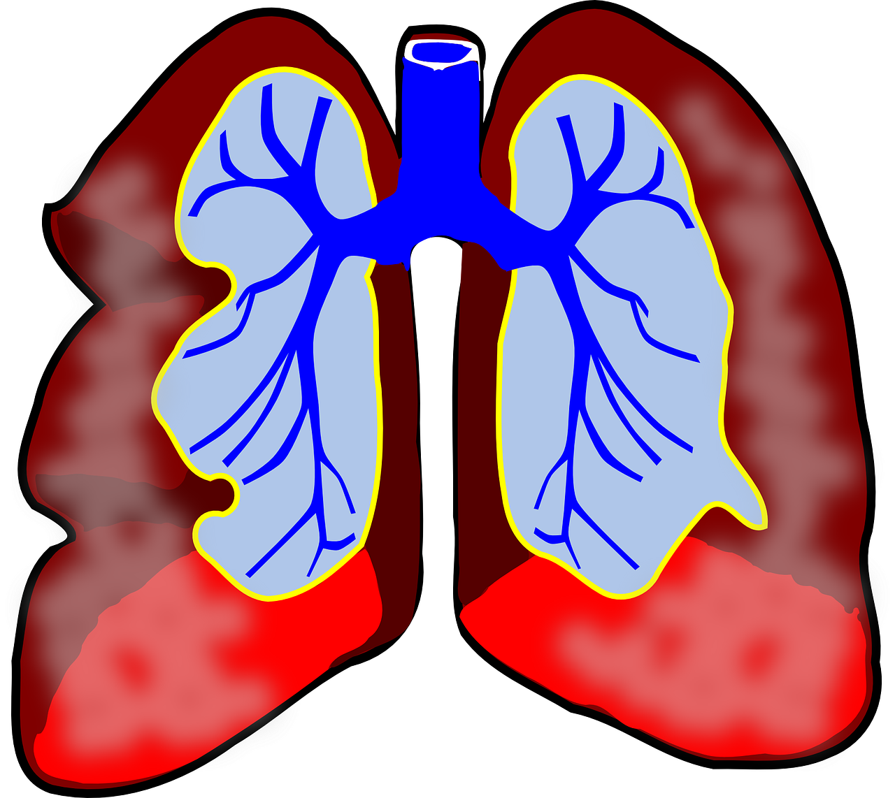 Asthma week st george. Cancer clipart pulmonology