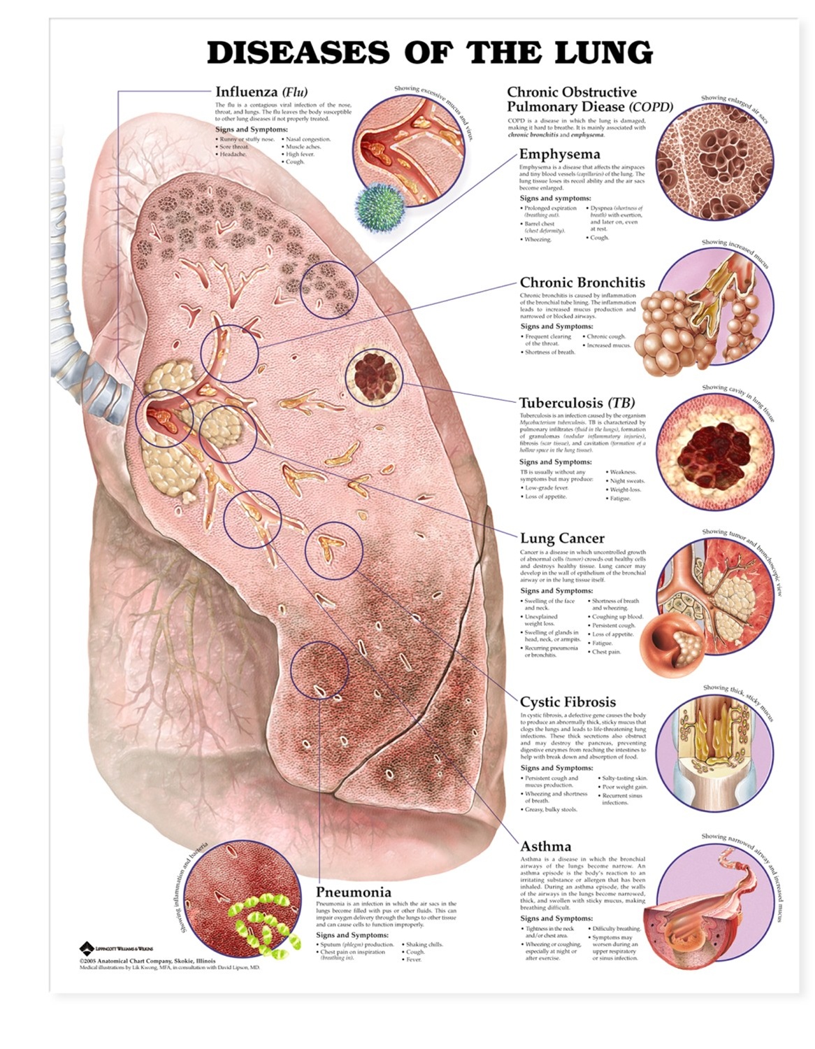 Cancer clipart pulmonology. Anatomy of lung fibrosis