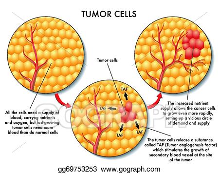 cancer clipart tumor