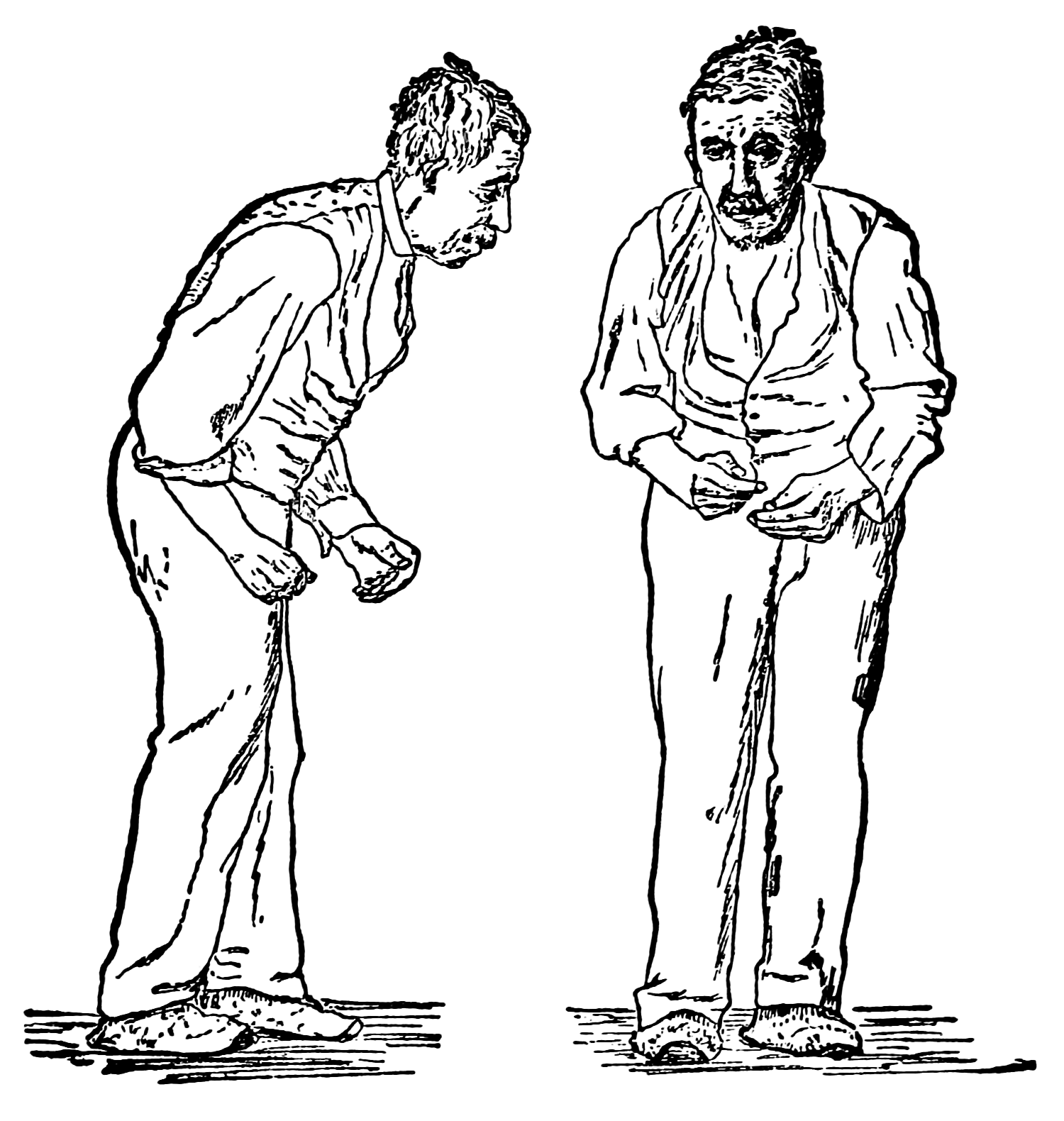 File paralysis agitans after. Movement clipart shake body