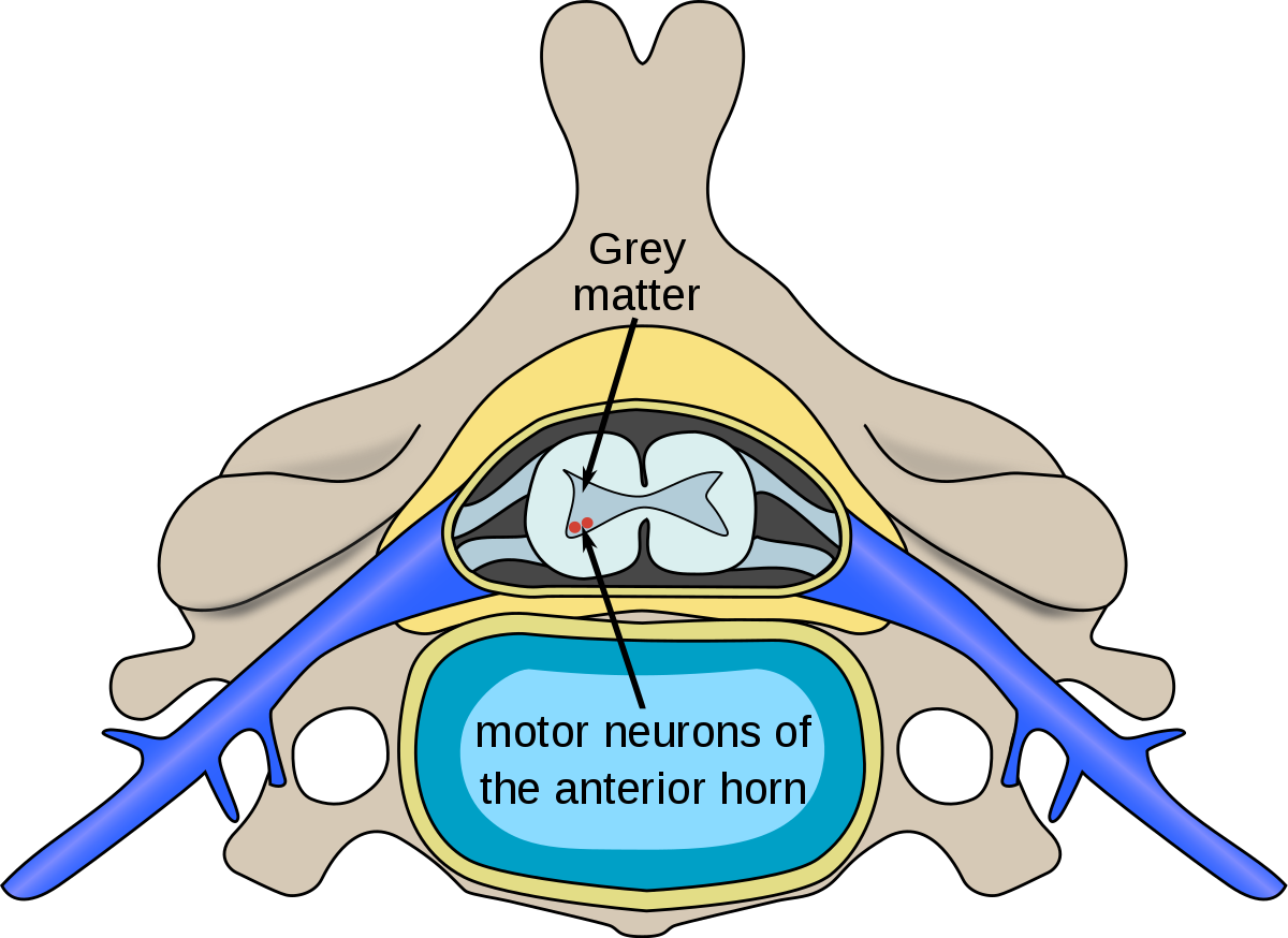 Horn clipart disturbance. Spinal muscular atrophy wikipedia