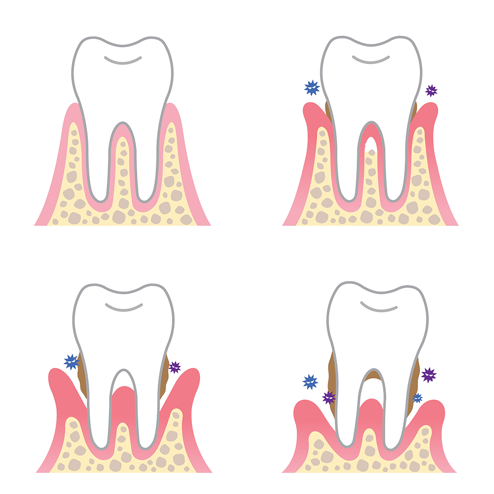 Dentist clipart lost tooth. How periodontal gum disease