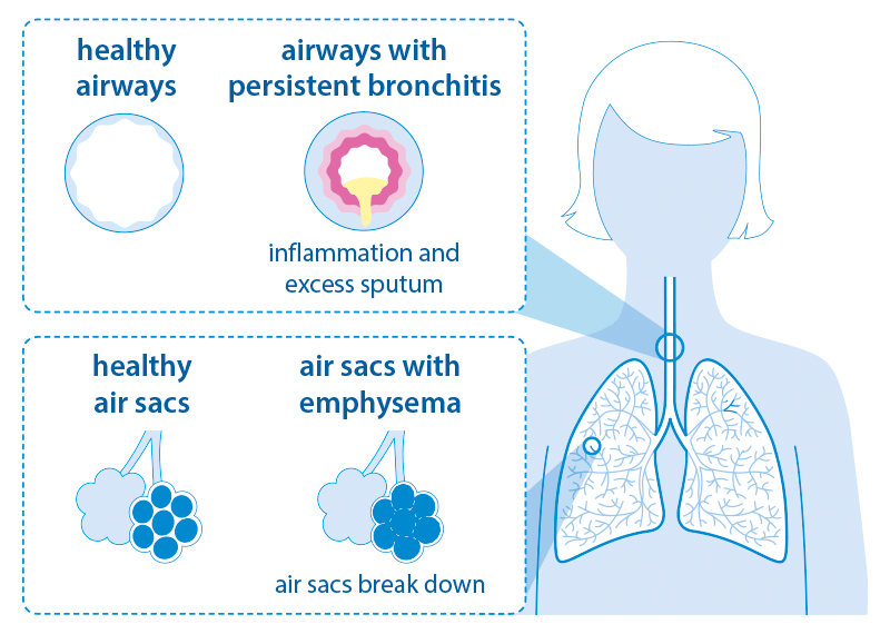 lungs clipart chronic bronchitis