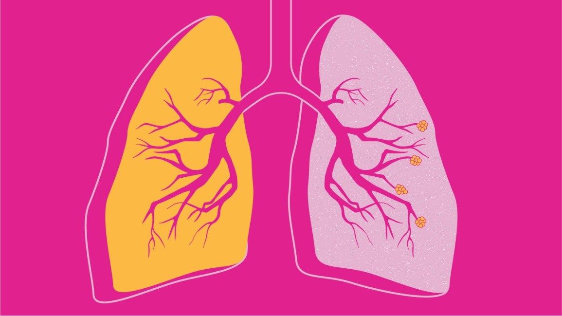 lungs clipart copd