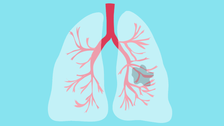 cough clipart lung cancer