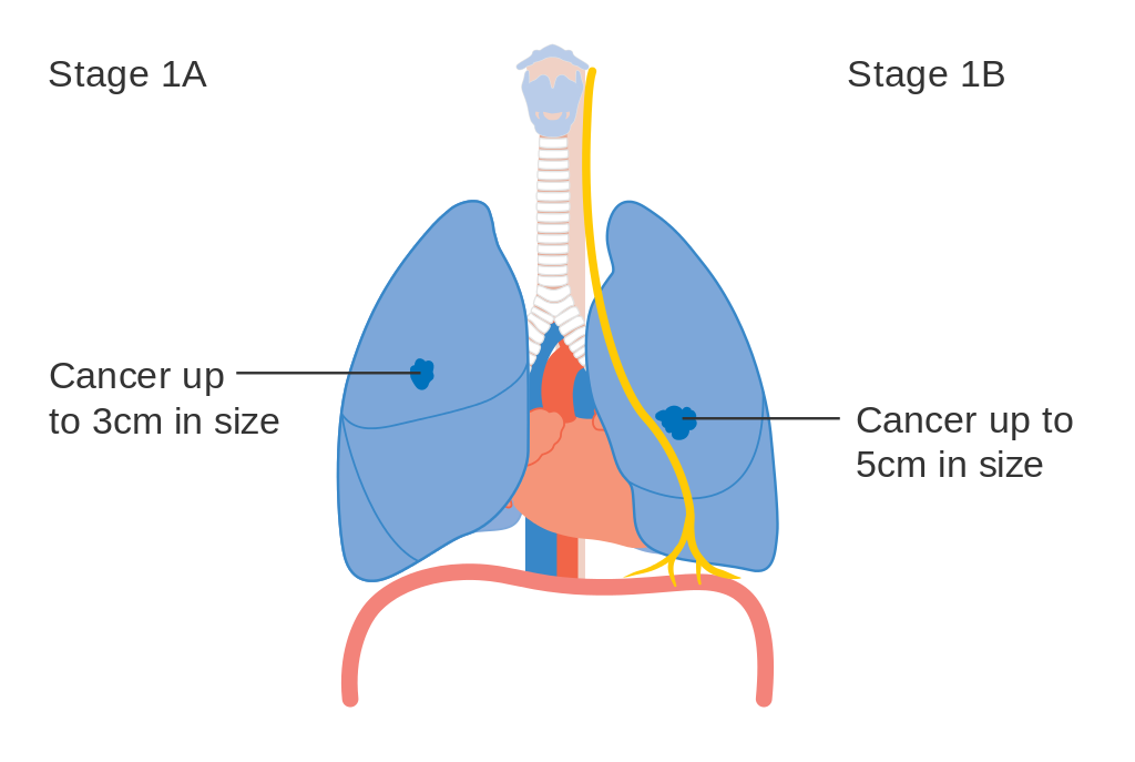 lungs clipart lung cancer