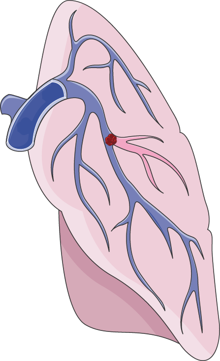 lungs clipart pulmonology