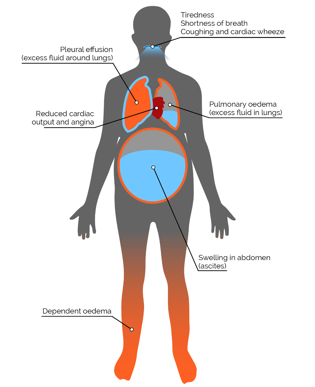 Cough clipart pulmonary circulation. Signs symptoms acute hf