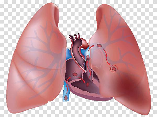Cough clipart pulmonary circulation. Embolism thrombus artery embolus