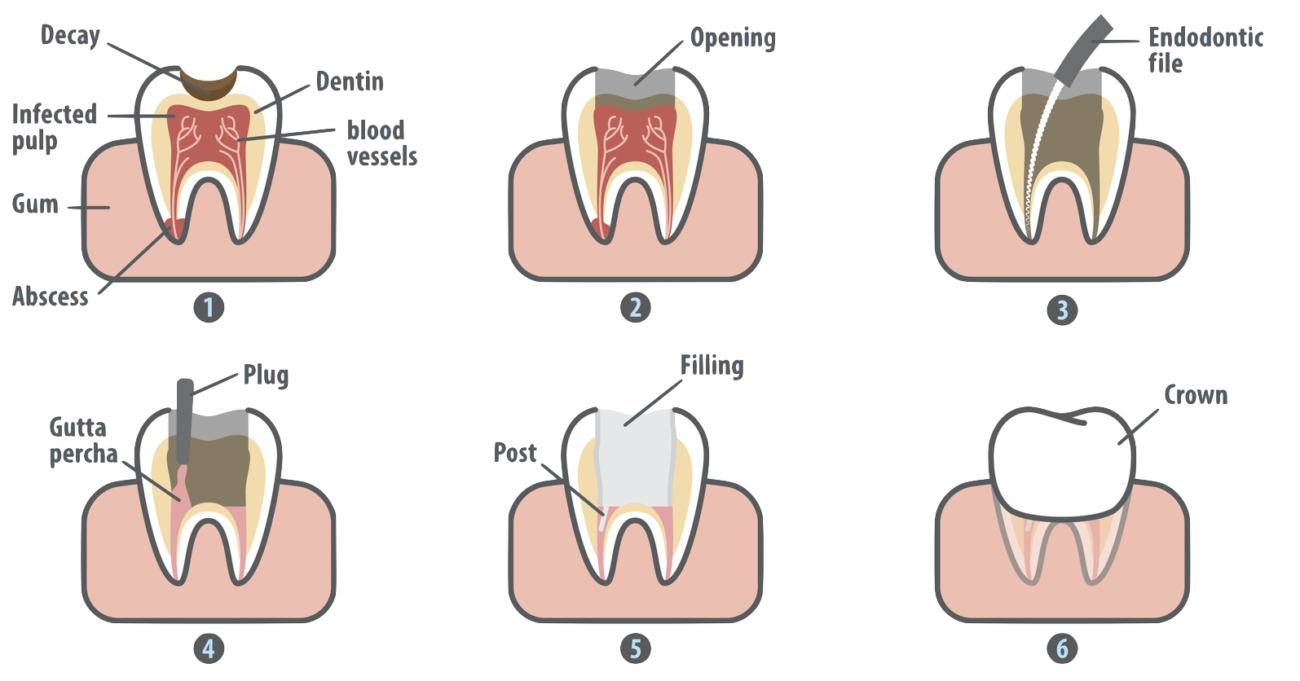 Root canal in marrero. Dental clipart dental crown