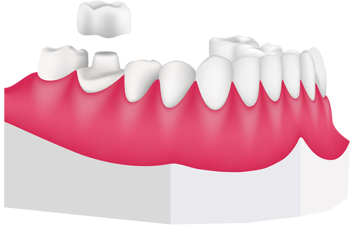 Dental clipart dental crown. Crowns for children richmond