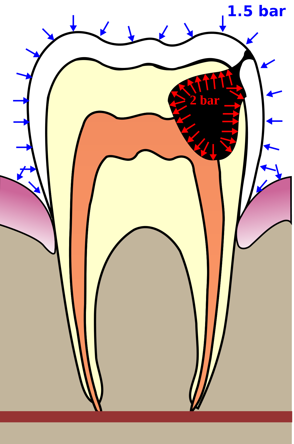 Barodontalgia wikipedia . Dental clipart dental history
