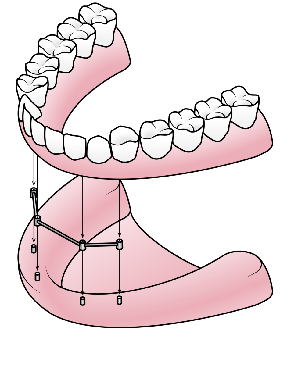 dental clipart dentures