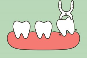 Dental clipart tooth extraction. Blog frisco tx stonebriar