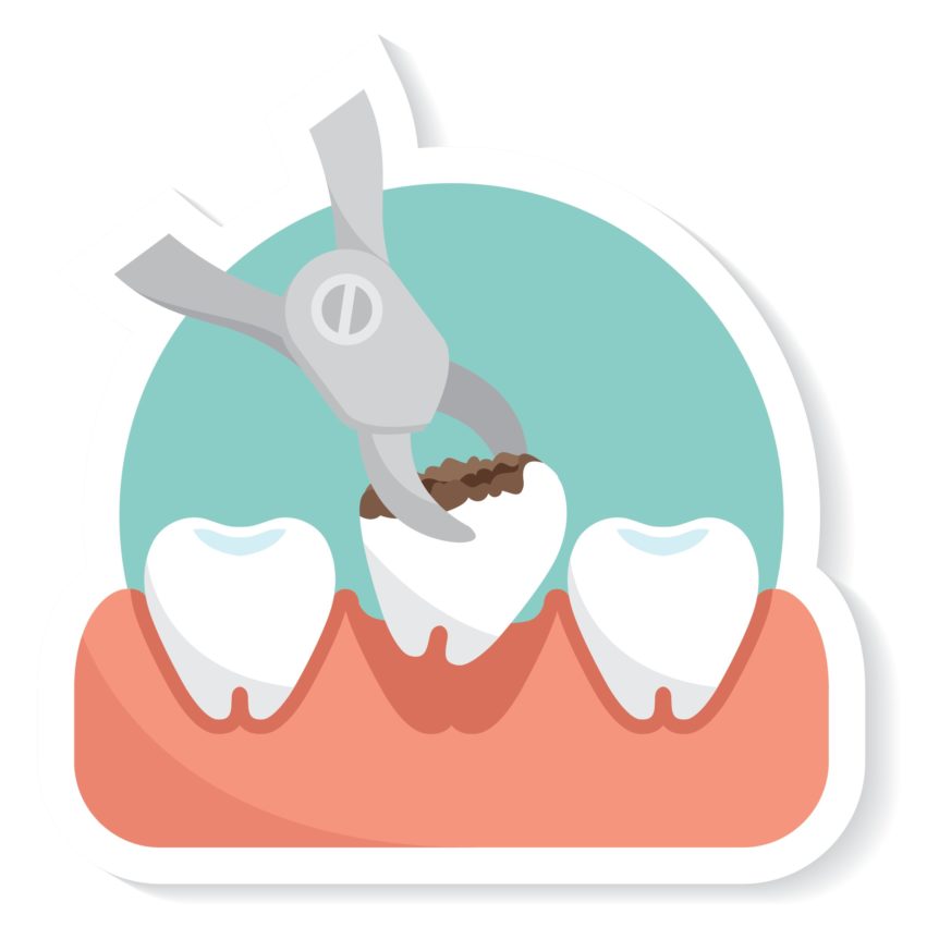 Dental clipart tooth extraction. Extractions crystal canyon family
