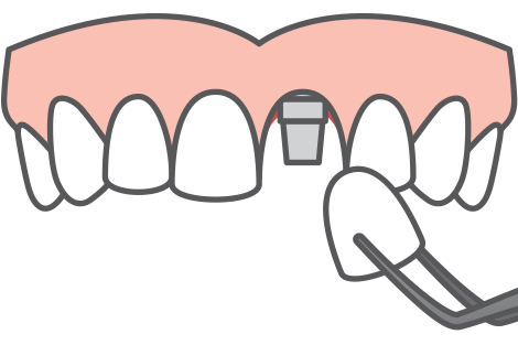 Dentist clipart one tooth. Dental implants in chicago