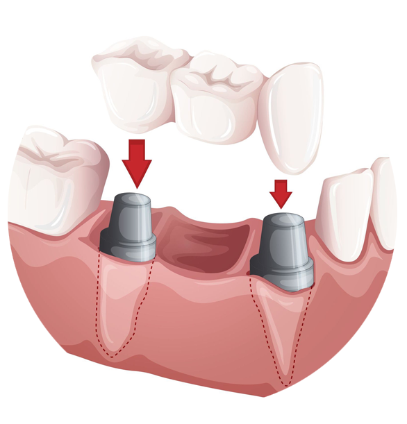 Dentist clipart single tooth. Multiple dental implants maryland