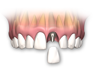Dentist clipart single tooth. Dental implants 