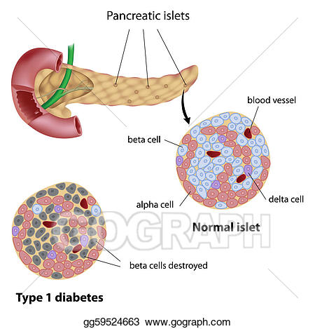 diabetes clipart pancreas diabetes