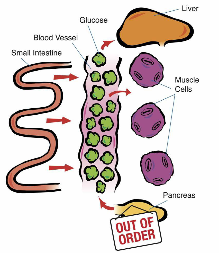 Diabetes clipart pancreas diabetes. Free type cliparts download
