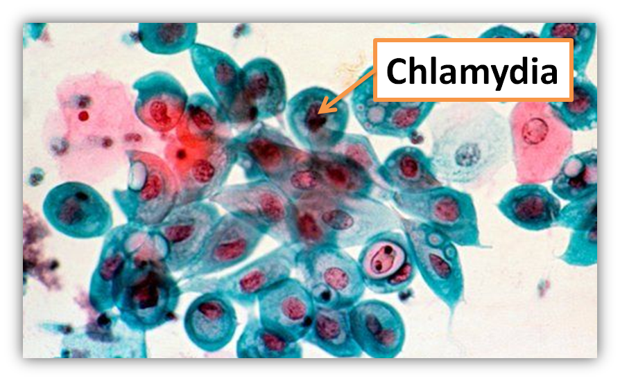 disease clipart chlamydia